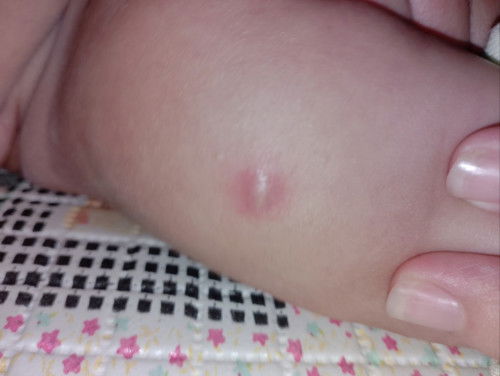 Bekas suntikan imunisasi