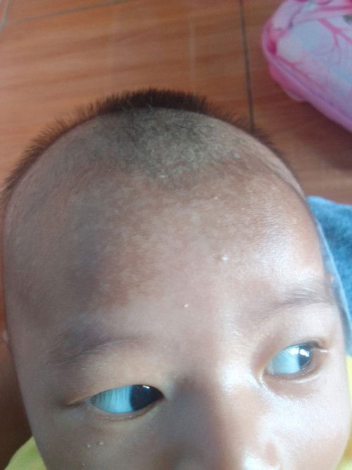 warna kulit tidak rata