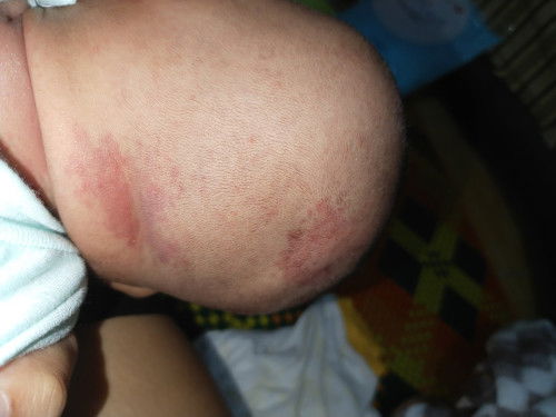 Tanda merah seperti gatal