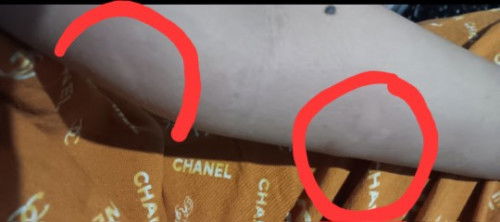 Gatal gatal pasca lahiran.