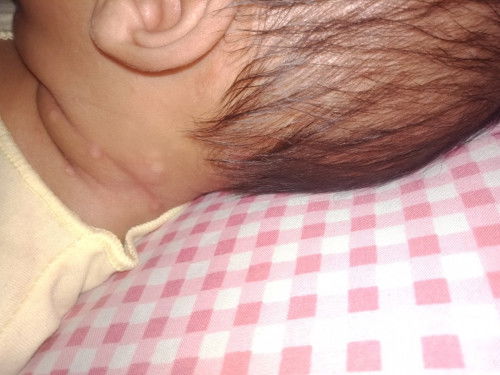 Merah-merah pada bayi