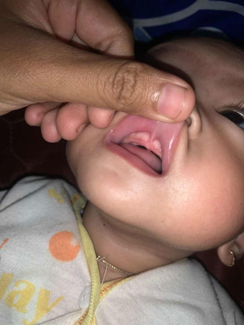 Lip tie pada bayi