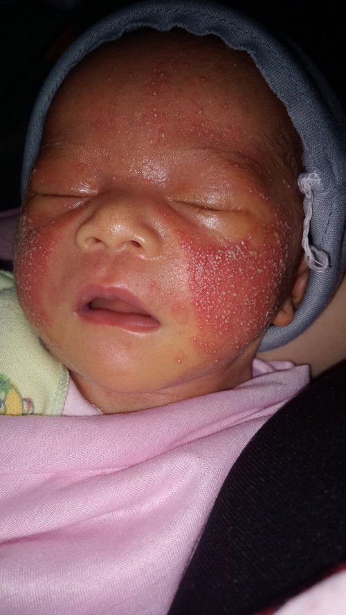 Ini kenapa ya baby saya baru 8 hari, setelah lahir 2 hari langsung merah² bintik gtu