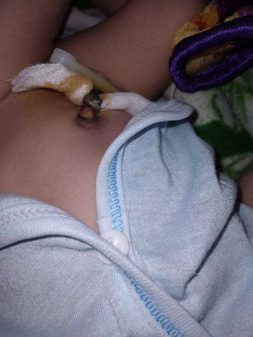 Tali pusar 2 minggu belum lepas