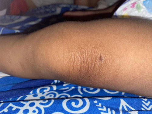 Kulit bayi merah lalu kering