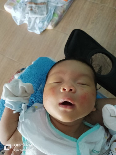น้องเป็นผื่นแบบนี้ ไม่ทราบว่า เป็นผื่นภูมแพ้ หรือว่าน้องแพ้นมไหมคะ น้องกินนมแม่ล้วนค่า