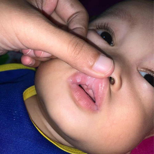Putih putih di mulut bayi