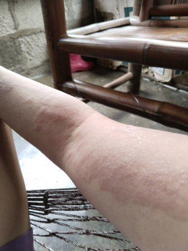 From prickly heat to red bumps