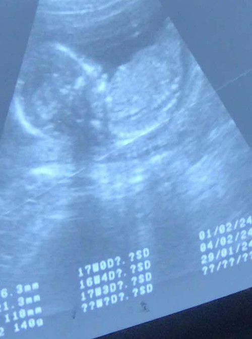 มาแชร์ภาพอันตราซาวด์กันค่ะแม่ๆ