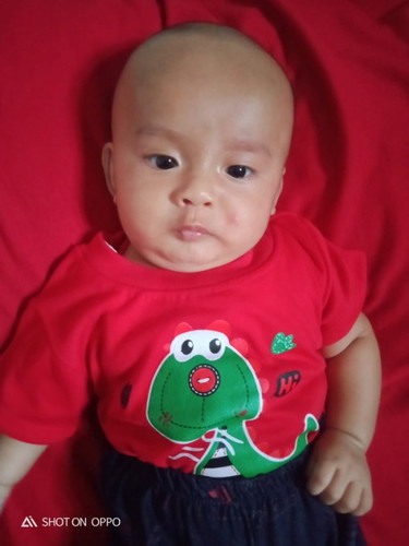 Bekas gigitan nyamuk