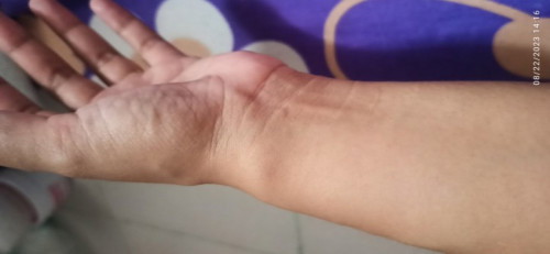 masakit na thumb at may bukol ang wrist