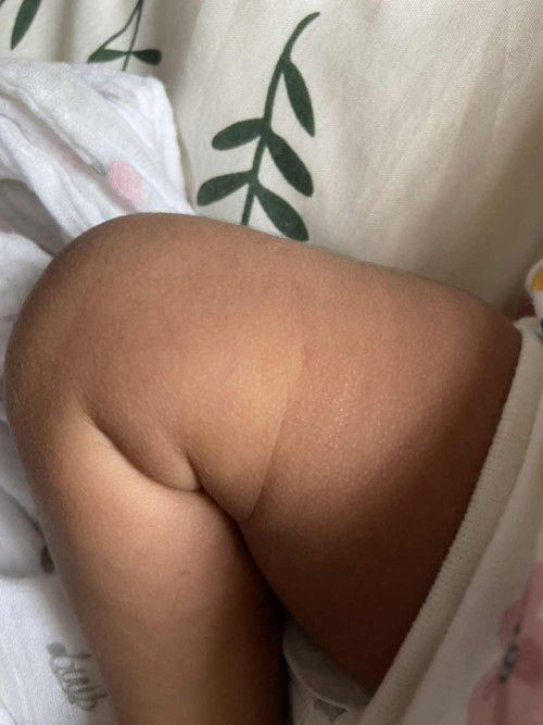 Kulit baby naik bintik