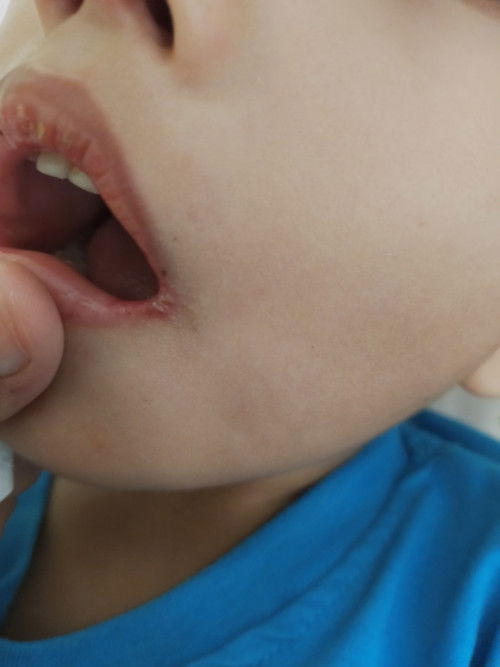 Sariawan di sudut bibir