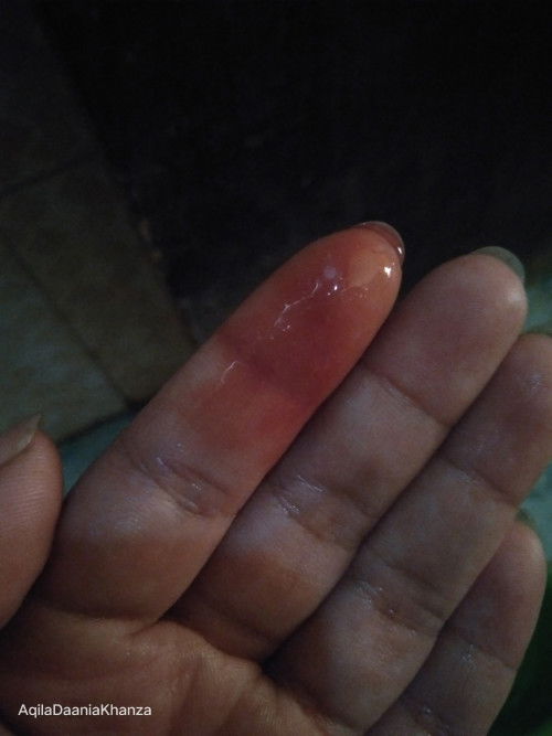 Flek di UK 19w tapi tidak sakit