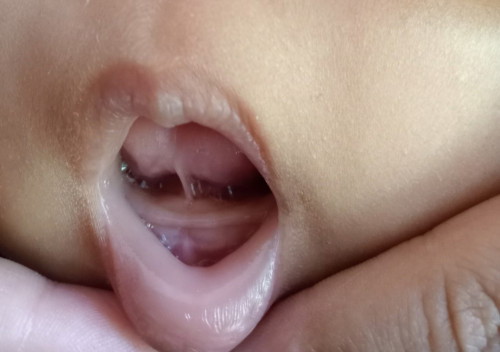 Tongue tie