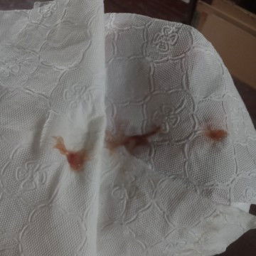 มีเลือดปนมูกออกมาแบบนี้ปกติมั้ยคะ