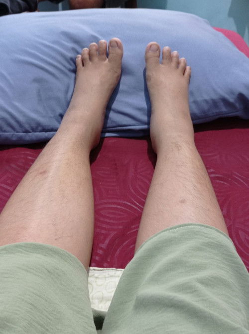 Kaki Bengkak Setelah Melahirkan Cara Menyembuhkan?