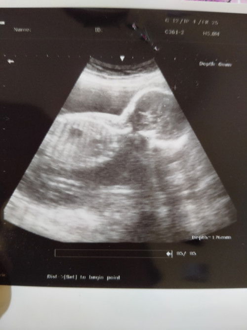 Bunda2 hpl tgl brp? Udh USG belum?