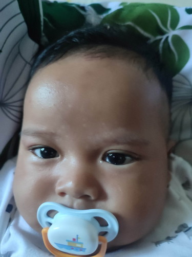 Ada bintik2 putih dijidat antara alis kanan kiri, cara menyembuhkan kira2 ada rekom obat/salep/bedak