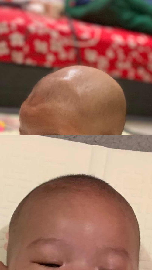 Soal garis seperti bando di kepala bayi 3 bulan