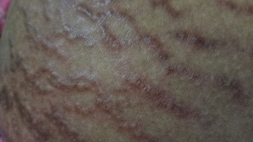 Bentol gatal gatal di seluruh badan