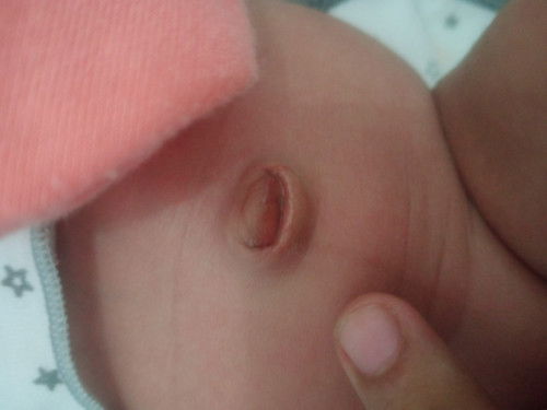 Tali pusar bayi umur 3minggu