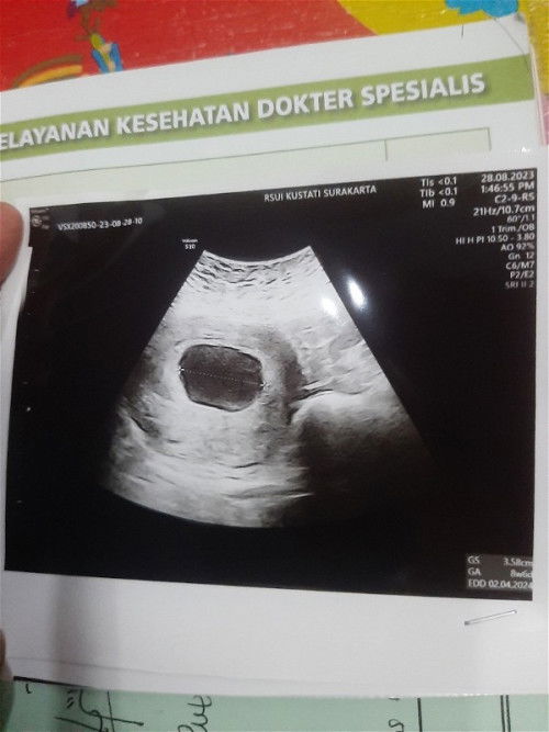 Sharing pengalaman janin kosong/ BO