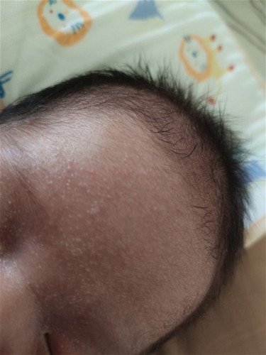 Bintik putih di wajah