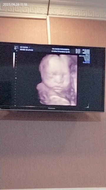 Hasil USG dan Hpht beda