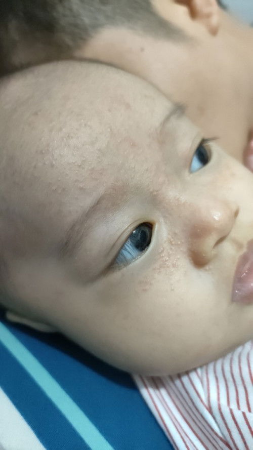 Jerawat kecil seperti biang keringat