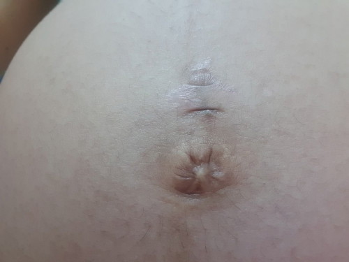 ท้องแตกลายช่วง 8-9 เดือน บ้านไหนรอดบอกบุญหน่อยจร้า