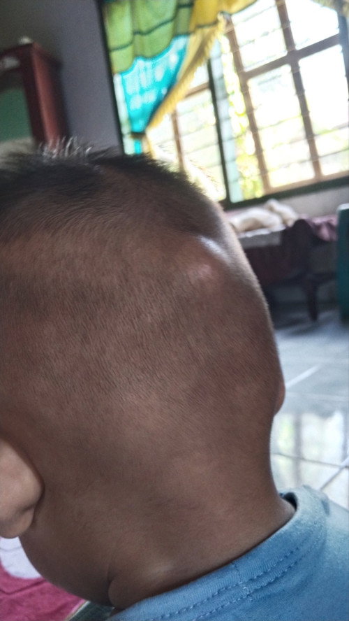 Benjolan seperti bis