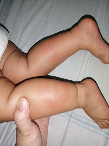 Mga mi ano kaya tong nasa binti ng baby ko?