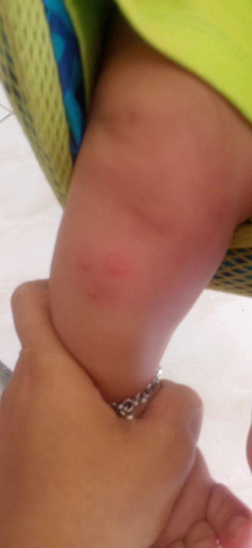 Bentolan di kulit bayi