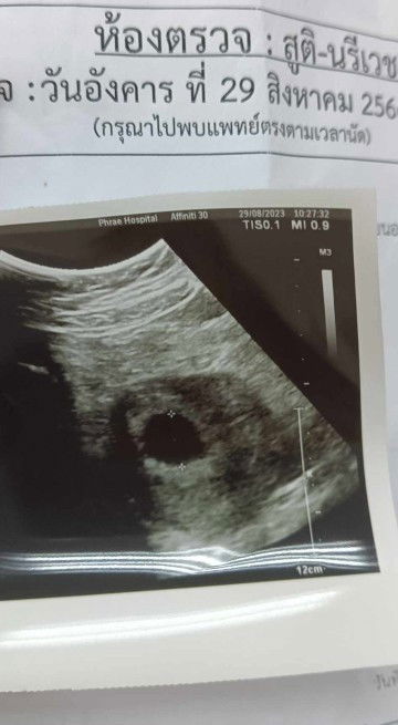 มีสิทธิ์ท้องลมไหมคะ 8สัปดาห์แล้วไม่เจอน้อง มีสิทธิ์ท้องลมกี่%ค่ะ