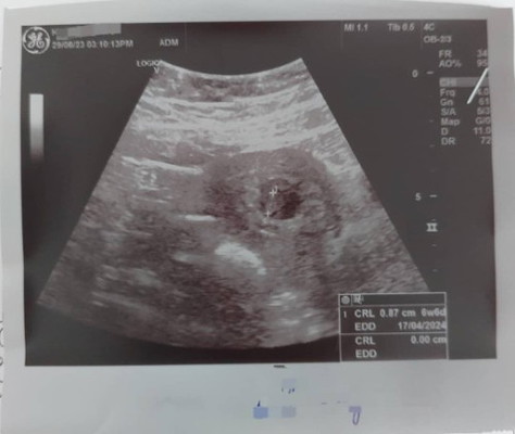 Update: Alhamdulillah 1st scan