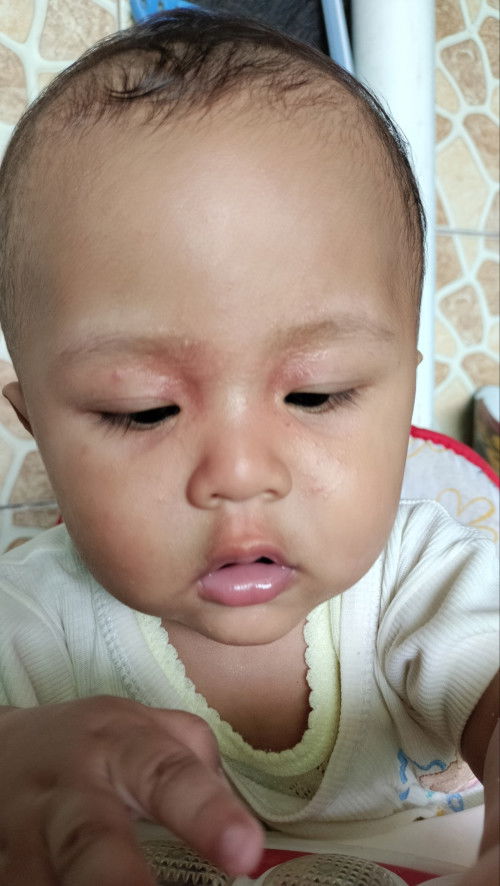 Biang keringat di bagian klopak mata