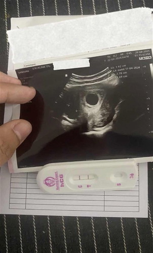 Normal ke Scan 6 weeks 6 hari bru nampak kantung je.