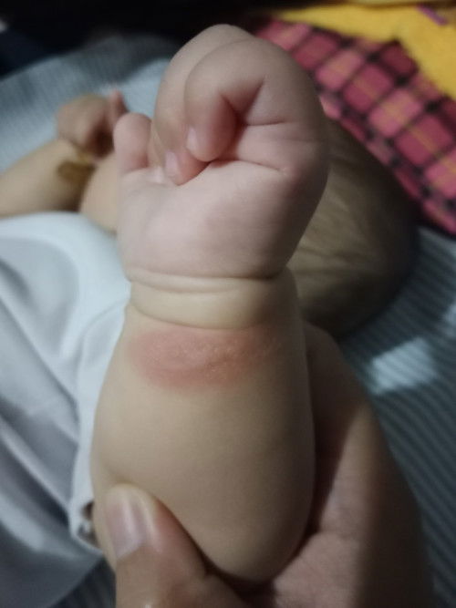 Pantal pantal sa katawan ni baby