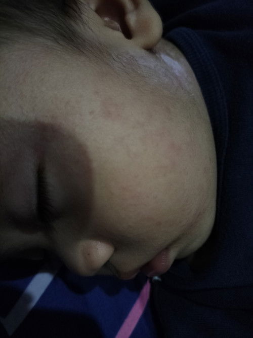 Bintik-bintik merah dan gatal