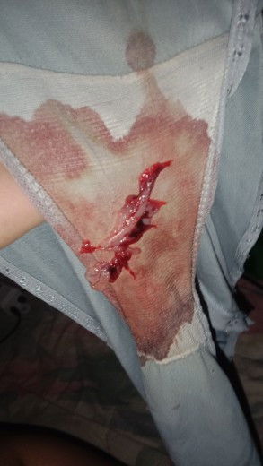 ประจำเดือนเพิ่งมาหลังจากคลอดลูก 74 วัน แต่ออกมาแบบนี้ ไม่รู้ว่าผิดปกติหรือผลข้างเคียงของยาคุมที่ฉีด