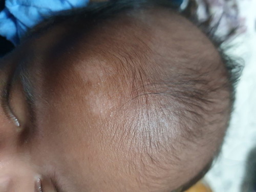 Face Blister after birth