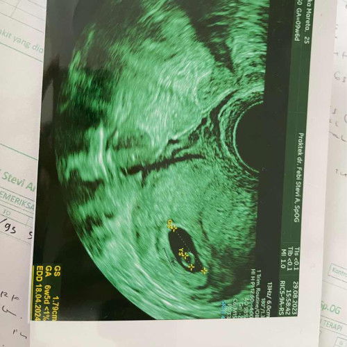 Usia Usg tidak sama dengan HPHT beda 3 minggu , ada flek, 6 minggu blm ada janin