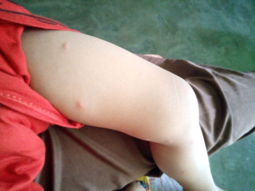 Gatal gatal apa penyebabnya