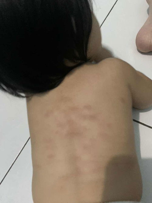 Eksim pada bayi 1 tahun