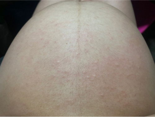 อายุครรภ์ 40+1  มีอาการคันผื่นขึ้นตามตัว คันมา 1 สัปดาห์ได้แล้ว !
#ใครเคยมีอาการนี้บ้าง?