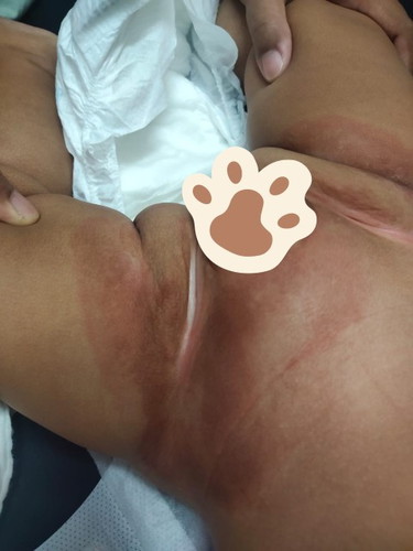 TOLONG SY!! BABY RASH/RUAM LAMPIN