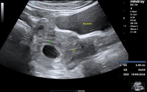 Kandungan 7w 2d..tadi pergi scan kandungan 6w 6d,tp takde fetal lagi..Ada tak sesiapa pernah alami