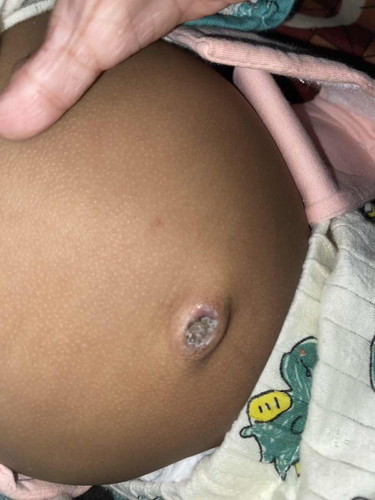 NORMAL LANG PO BA GANTONG PUSOD NG 9 MONTHS OLD BABY PARA PONG NAG LALANGIB