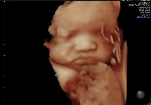 Anomali tulang hidung